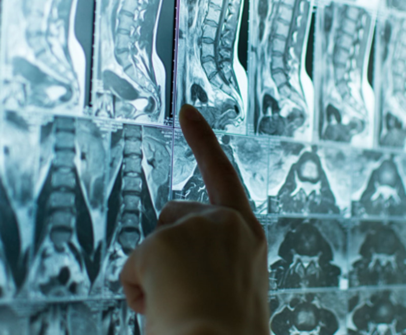 Корешковый синдром